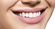 Tooth whitening | Oral Health Foundation