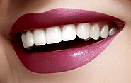 Teeth Whitening in Marylebone