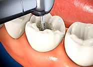 Know More about Root Canal Treatment - Pinnacle Dental