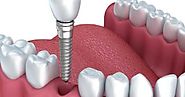 Improve Your Smile with Dental Implants