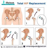 If your hip has been damaged by... - Shriram Knee Replacement Center | Facebook