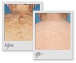 Laser Hair Removal - Urban Beauty Thailand