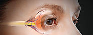 How does Glaucoma work? | A Look into the Latest Developments of Glaucoma Treatment