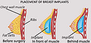 Breast Augmentation - Arra Aesthetics in Pune, India