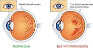 Diabetic Retinopathy: Causes and Symptoms – Intolife