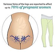 Vulvar Varicosities: Symptoms, Causes & More - Don’t Be Afraid To Talk About It
