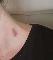 14 Effective Ways to Get Rid of Hickeys and Stop The Embarrassment