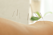 Know about Acupuncture as it Helps in Relieving Chronic Pain | Viva Healthy Life Blog