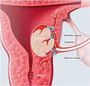 Find the Benefits of Uterine Fibroid Embolization with USA Fibroid Center