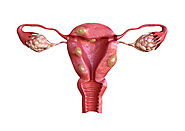 Fibroid Uterus Unveiled: Exploring Images and Insights
