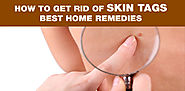 How To Get Rid of Skin Tags | Getting Rid of Skin Tags