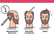 Why Hair Grafts Fall After Hair Transplant? – Laserskincareae