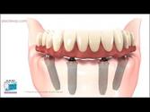 All on 4 Dental Implants in Los Algodones Mexico | PlacidWay