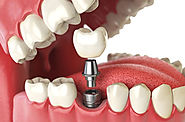 Best Dental Implant In Kolkata | Dental Implant Clinic in kolkata