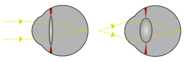 Why Are People Nearsighted or Farsighted?