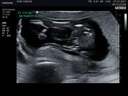 Confirm Baby's Sex with an Accurate Gender Determination Scan