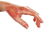 Burn Injuries and the Available Legal Options