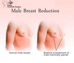 Solution to enlarged male breasts