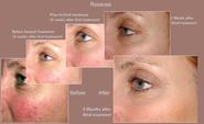 Rosacea treatment in dubai