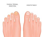 Do You Know How To Treat Your Toenail Fungus?
