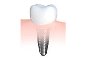 Dentist Modesto | Implant Dentures Modesto