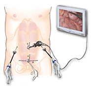 Laparoscopic (Keyhole) surgeries for all feasible conditions