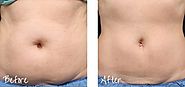 CoolSculpting® Portland | Non-Surgical Fat Reduction