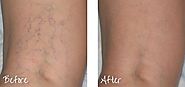 Sclerotherapy Portland OR | Spider Vein Treatment