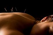 Acupuncture: Does It Work?