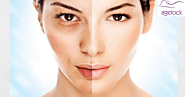 Opt for Best Melasma Treatment for a Flawless Looking Skin
