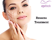 Know About Rosacea and its different Treatment Procedures Available