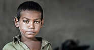 Moderate Acute Malnutrition - Signs to Look Out For
