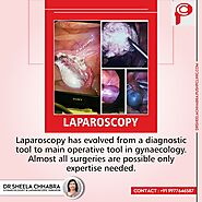 Laparoscopy