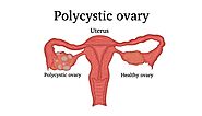 Polycystic Ovarian Syndrome (PCOS) | Dr Sheela Chhabra