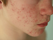 Home Remedies For Acne (Pimples) - Symptoms, Causes & Prevention