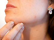Home Remedies For Blemished Skin | Cure Blemished Skin At Home