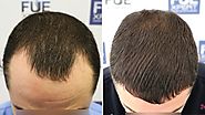 Hair Transplant in Pakistan | Posts by waqqas ashraf | Bloglovin’