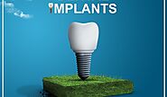 Dental Implant Clinic In India