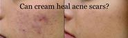 Best Acne Scar Removal