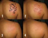 Laser Tattoo Removal in Bangalore.