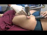 Best Stretch Mark Removal Treatment in Bangalore