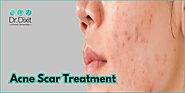 Acne Scar Treatment in Bangalore