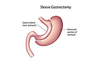 Laparoscopic Gastrectomy Sleeve Surgical Weight Loss Procedure
