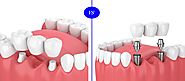 What Are Bridges In Dentistry? | Henderson Cosmetic Dentist Blog | Marielaina Perrone DDS