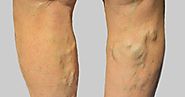 Advanced Vein Therapy For Varicose Vein