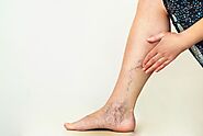 Varicose Vein Stripping Helps in Reliving the Symptoms of Venous Ulcer