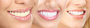 Teeth Whitening in Dubai at Affordable Cost: Cross Roads Dental Clinic