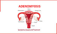 The Symptoms, Causes and treatment of Adenomyosis - Indira IVF