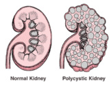 Customer Reviews on Polycystic Kidney Disease Treatment 2016