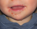 Hand Foot & Mouth Disease